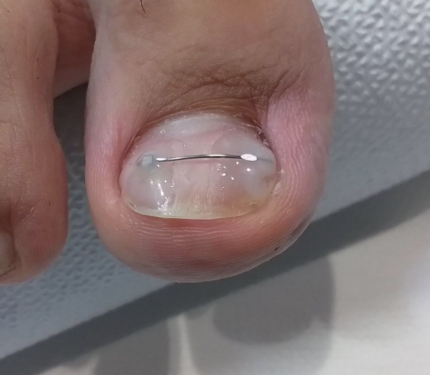 교정장치 적용 후