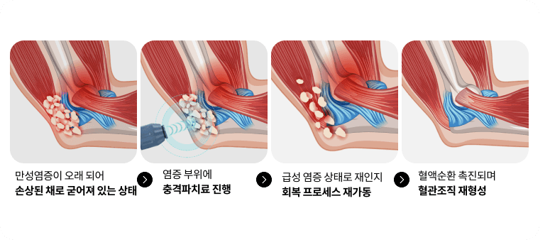 충격파 치료 회복 과정 4단계